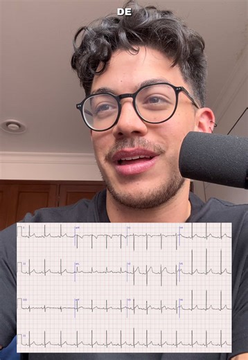 El ECG si estuvo regalado. Día 140/1825 leyendo un ECG al día hasta convertirme en Cardiólogo #ecg #ekg #estudiantemedicina #electrocardiograma