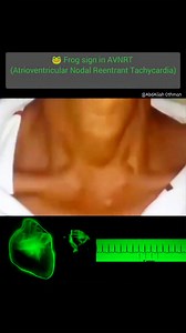 77K views · 424 reactions |  The "Frog Sign" in AVNRT: A Key...