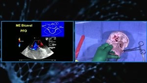 The Interatrial Septum: Correlating Anatomy, Imaging, and Intervention