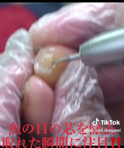 魚の目ケアと痛くないフットケアの手法