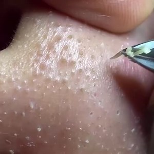 whitehead extraction