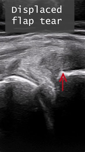 Can Ultrasound Show Meniscus Tears as Well as MRI? Horizontal vs Displaced Flap