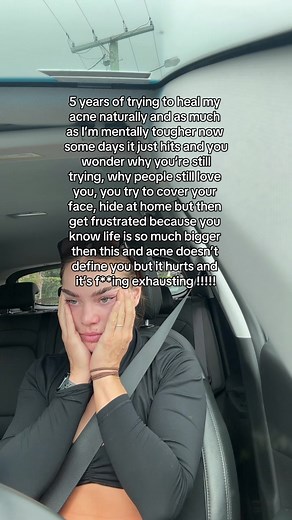 Overcoming Acne: A Journey of Resilience and Self-Acceptance