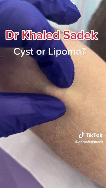 Cyst or lipoma #drkhaledsadek #cystremoval #skincare | lipoma