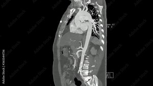 Computed Tomography of the Aorta from the chest to the pelvis in sagittal plane cine mode (Abdominal Aortogram CT)