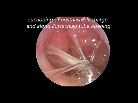 Endoscopic Myringotomy, Suctioning of Middle Ear Mucous and Grommet Insertion