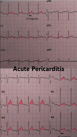 Acute Pericarditis ECG: Widespread ST-segment elevation