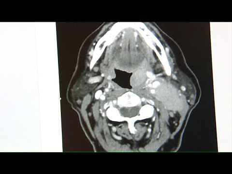 Death of Beth Chapman shines light on rise in throat cancers