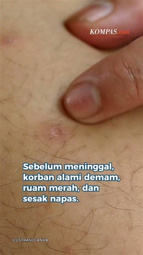 Kasus Dokter Meninggal Suspek Campak, Kemenkes Ingatkan Risiko pada Dewasa