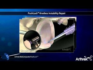 Arthrex PushLock Knotless Instability Repair