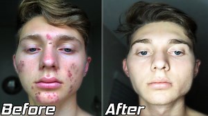 How I Cleared My Acne? | Acne Transformation Story (2020)