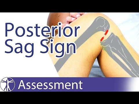 Posterior Sag Sign | Posterior Cruciate Ligament Tear