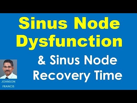 Sinus Node Dysfunction and Sinus Node Recovery Time