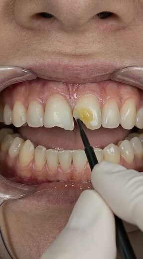 Fixing a Chipped Front Tooth: Composite Bonding 🦷✨