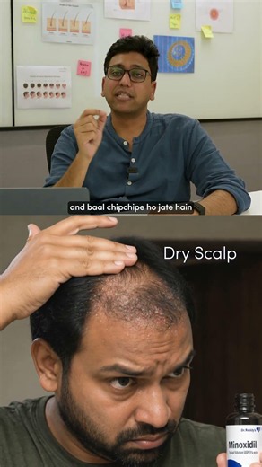 Why Regular Minoxidil Doesn't Work for Everyone?