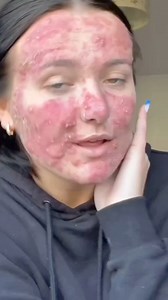 This is what happens to your skin if you eat dark chocolate every day. #health #darkchoclate #choclate #facts | Health Wellnes