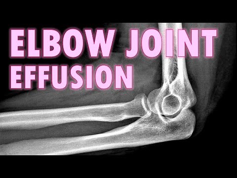 Elbow Joint Effusion - Sail Sign