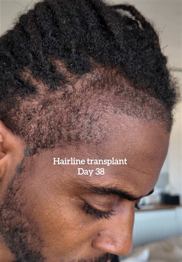 Effective Hairline Transplant Techniques for Locs