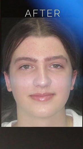 Otoplasty (Ear Pinning Surgery) Results: Before & After Pictures #cosmeticsurgery