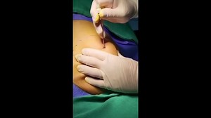 Removal of Giant Lipoma with Minimally Invasive Technique by Dr. Ajaya Kashyap
