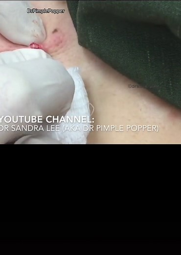 Best Steatocystoma Videos Compilation