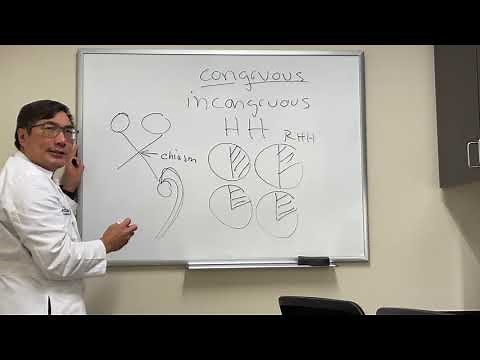 Congruous vs. incongruous homonymous hemianopsia