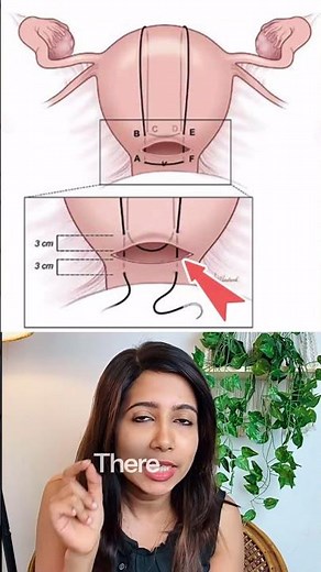 B lynch vs Hayman suture #neetpg #fmge