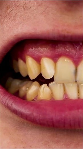 Tooth Discoloration: Understanding the Causes & Its Treatments | Dental House MI #shorts