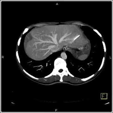 Abdomen: Liver: Cavernous Hemangioma of the Liver(9 of 9)