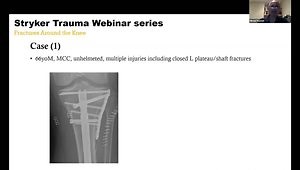 Complex Knee Fractures