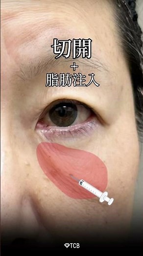 【目の下のたるみ】このたるんだ皮膚を取るとどうなる？
