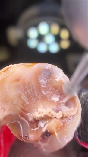 Selective Caries Removal | Dental Macro #dentalcare #dentist #wisdomtoothextraction #satisfying