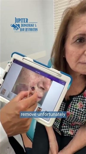 Lip Reconstruction: Mohs Surgery & Rotation Flap Repair