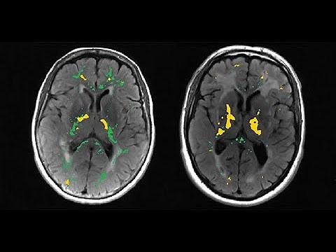 Microglial activation and blood–brain barrier permeability in cerebral small vessel disease