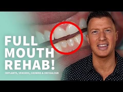 Amazing Full Mouth Rehab with Dental Implants, Veneers, and Crowns after Invisalign • Part 1 of 2
