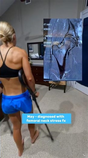 Femoral Neck Stress Fracture Recovery