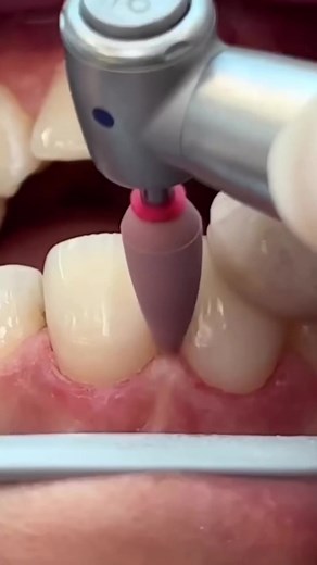 Dental Veneers Application Process Explained