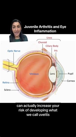 Did you know that having Juvenile Arthritis can affect the eyes?