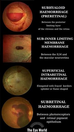 retinal hemorrhage types