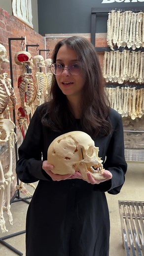 Embark on a captivating journey into craniotomies at the Bone Museum. A craniotomy, a precise surgical procedure, involves the temporary removal of a portion of the skull, granting access to the intricate landscape of the brain. Witness the delicate balance of medical artistry as you explore the details of this process through a carefully showcased skull. Located at 255 McKibben Studio 14, the Bone Museum invites you to unravel the wonders of neuroscience in a unique and educational exhibit. Don