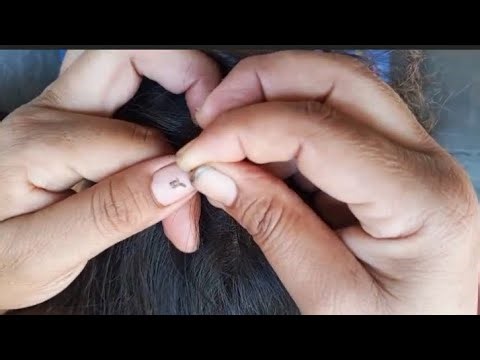 Lice and Nits Removal from Hair | Complete Cleaning Process