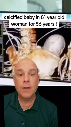 A calcified “stone baby” was found in an 81-year-old woman where it was hidden for 56 years! Unbelievable but true ectopic pregnancy. Can you believe it? #stonebaby #calcified #ectopicpregnancy #womenshealth #infertility #IVF #ttc #infertilitywarrior #ivfwarrior #infertilityjourney #Reels #reelsvideo #reelsviral #reelinstagram | Steven Palter