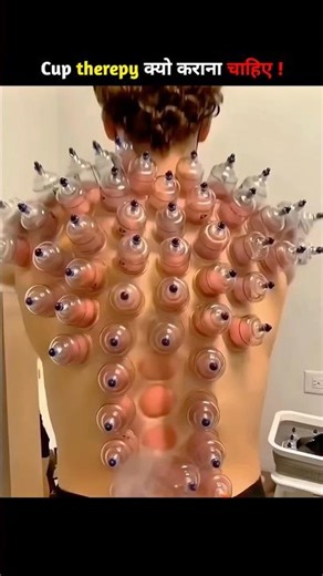 Why should you try cup therapy ? #cuppingtherapy #facts #shorts #viral