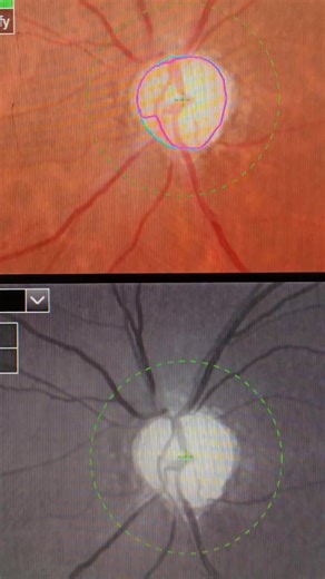 Ather Eyecare on Instagram: "Guess the CD ratio for both eyes #Eyecare #Optometrist #learning #eyehealth #Macula #foryouシ #ophthalmology #reelschallenge #athereyecare #edema"