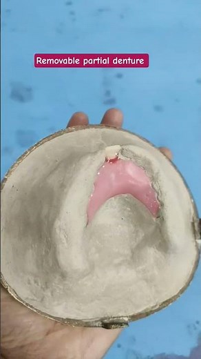 Removable partial denture