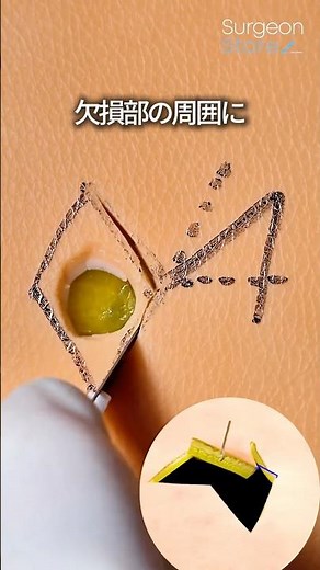 Reasons for increasing wounds