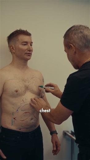 Men's Chest Fat - Liposuction