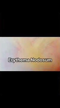 Erythema Nodosum