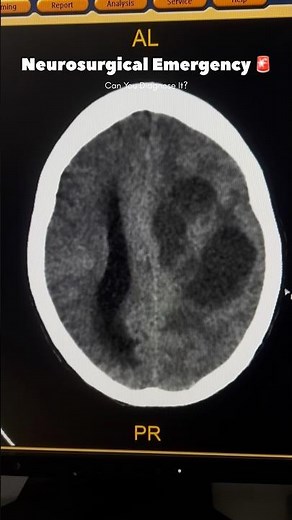 High Grade Glioma CT Brain Case | Midline Shift & Herniation #shorts