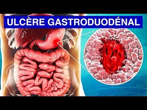 ULCÈRE DE L'ESTOMAC (Gastroduodénal) : Causes, Symptômes et Traitements